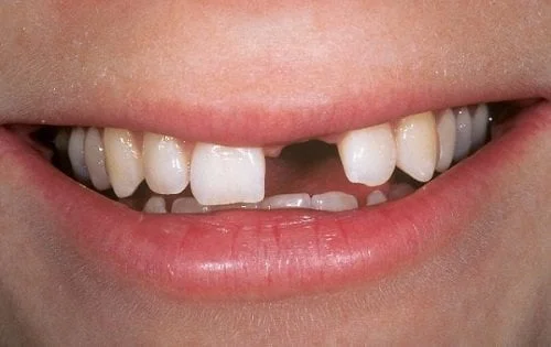 Người mất 1 hoặc nhiều răng