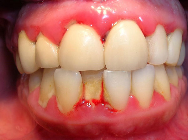 Nướu chảy máu, sưng đỏ là dấu hiệu nhận biết sớm viêm nha chu