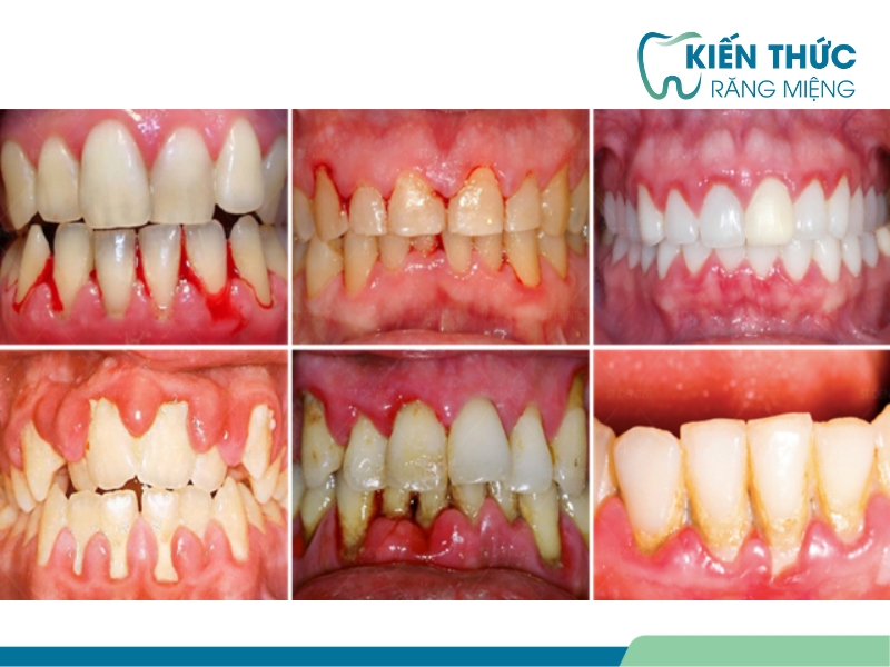 mất răng do phát hiện viêm nha chu muộn